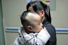 4个月男婴医院打吊针 护士拔针不慎粘掉其一块头皮